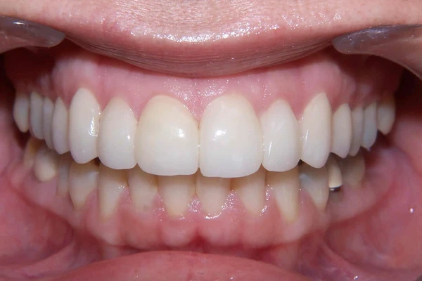 After smile photo 3