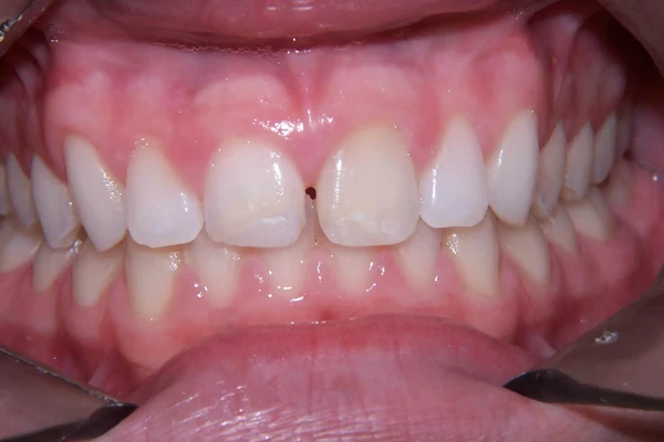 Before smile photo 2