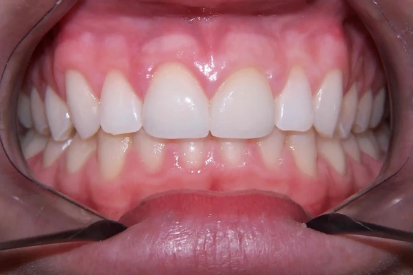 After smile photo 2
