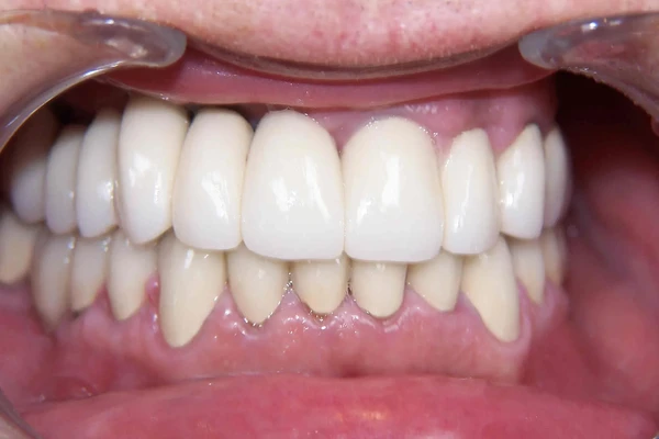 After smile photo 1